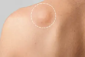 身上长了“脂肪瘤”，不痛不痒，需要治疗吗？医生：主要看这几点图片