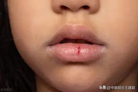 嘴唇干裂起皮，别以为是缺水了，可能是这里出了问题！图片