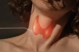 甲状腺功能五项检查是什么？图片