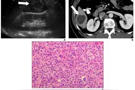 人体会有多少种肿瘤出现？图片