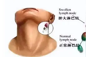 真相：肺癌的转移速度有多快？取决于这3点因素！图片