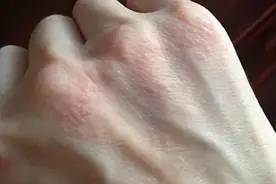 两味药，去除湿热，专门治疗湿疹、荨麻疹等瘙痒性皮肤病皮肤病图片