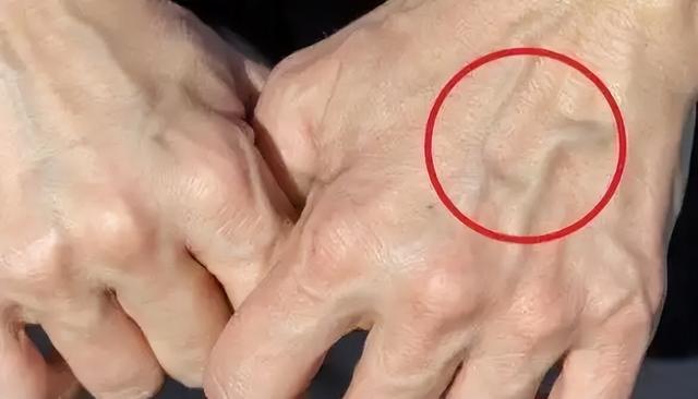 血管年轻，人才年轻！手背血管有这6个特点，恭喜你容易长寿
