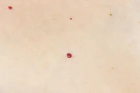 身上的小红点到底是什么？有些拖着不管可能病变图片