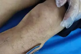 尿酸正常，但还是患痛风了，咋回事？原来真相是这样的图片