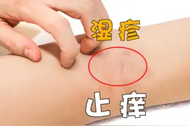 顽固湿疹有救！苦参丸新功效，权威称止痒效果翻倍图片