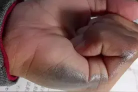 小时候扎的铅笔印还没有消？揭秘：铅笔在皮肤上留下印记的秘密。图片