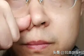 流鼻血了，激素鼻喷还能继续用吗?图片