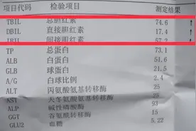 胆红素升高，先不要恐慌，这5种情况，肝脏无大碍图片