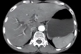 胆管细胞癌的影像诊断图片