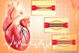 冠脉放了支架，这两项基础治疗要坚持图片