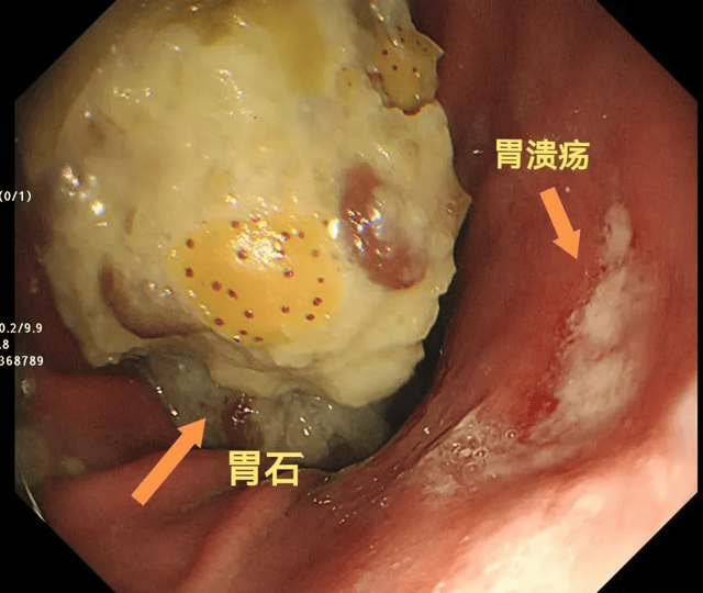柿子受到关注！医生研究发现：常吃柿子的人，或会收获5大好处