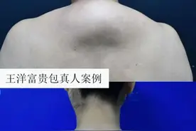6年富贵包头晕头沉！70分钟改善，做完我就后悔了！图片