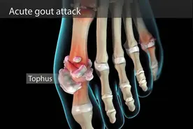 痛风患者鱼都不能吃？并非如此，快来看看鱼类嘌呤含量表图片