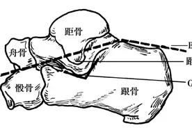 收藏 | 跟骨骨折手术入路及方式图片