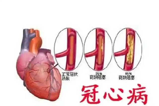 冠心病是严重疾病吗？关键情况别忽视