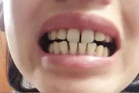 孩子牙缝大不美观，需要做牙齿矫正吗？图片