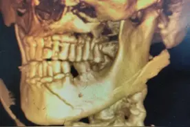 口腔颌面部骨折：脸“碎”了还能拼回去吗？保命又保颜的硬核操作图片