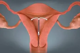 上环的女性要注意哪些？图片