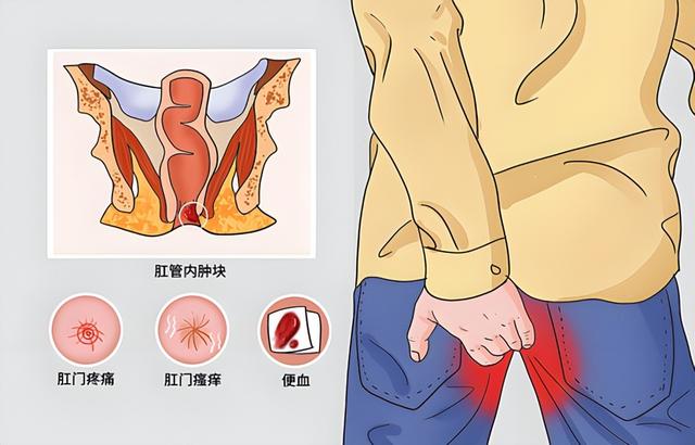 你有“洗屁股”的习惯吗？忠告：经常清洗肛门，或可带来5种好处