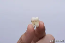 拔牙补牙，我的惨痛教训希望可以让看到的人引以为戒，莫重蹈覆辙图片
