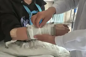 桡骨远端骨折的定义是什么？应该采用什么方法治疗？图片