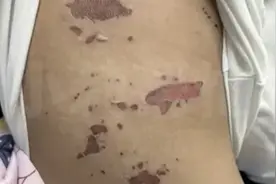吃火锅烫嘴后竟全身溃烂！医生：有传染性图片