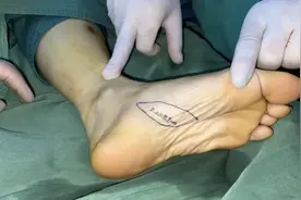 当工伤热烫伤发生后，如何用技术给手指“续命”图片