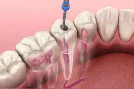 根管治疗不要随便做，能不做就不做！图片