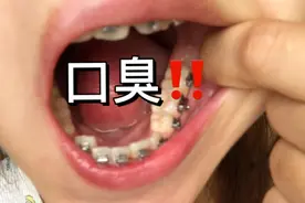 1分钟讲清去除口臭最佳方法！别再去洗牙了！图片