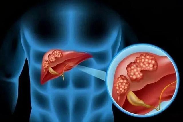 63岁男子皮肤瘙痒，以为是皮肤病	，体检后，医生叹：怎么不早来