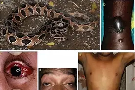 可怕程度远超银环蛇！蝰蛇咬伤后吐血不止，国内无血清只能等死？图片