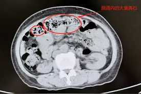 肠道被“石头”堵了一半腹胀如球，提醒：连续多日便秘尽早去医院图片