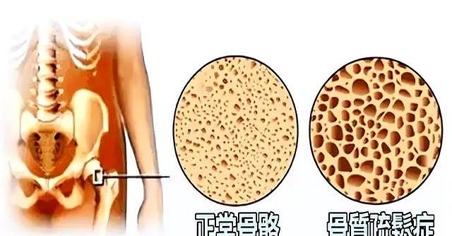 学医后才明白，增强骨密度最好的运动，不是散步游泳，而是这个