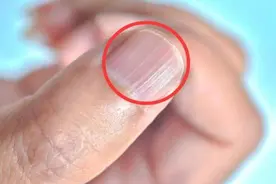 为什么指甲上有竖纹？指甲若出现4种异常，或是几种问题的信号图片