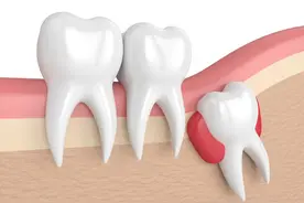 长智齿好痛该如何缓解?图片