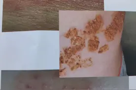 腰上长了一串小红点是带状疱疹吗？到底怎么样的疹子是带状疱疹图片