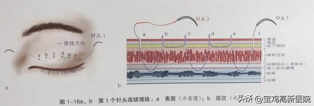 想做双眼皮?请查收这份攻略