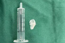 重庆游客品尝美食遭异物卡喉，武汉医生3分钟完整取出扇形鱼骨图片