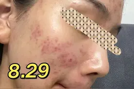 学会这几招终身受益！红黑痘印自己就能消，根本不用乱花冤枉钱！图片