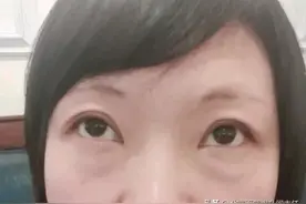 35岁，到北京做眼袋手术，恢复了19天，术后真实经历分享给大家图片