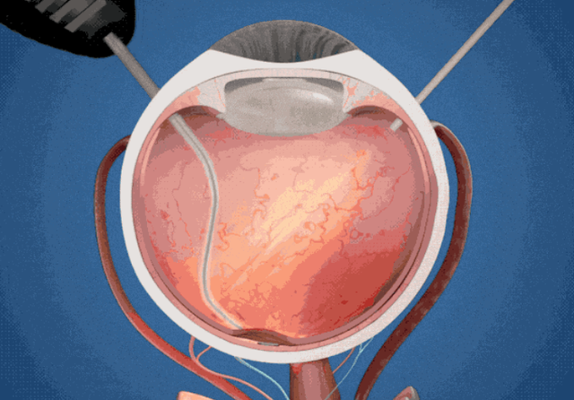 70岁奶奶失明15年，靠2毫米芯片重见光明，连罐头标签都能看清！