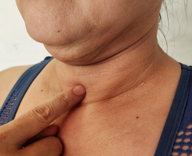 50岁女子脖子长疙瘩以为是脂肪粒，确诊HPV！医生：这些部位注意