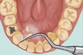 牙缝里的牙结石，自己能抠掉吗？牢记3个方法，还自己一口好牙图片