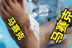 是不是糖尿病人最后都会得糖尿病足（脚）？图片