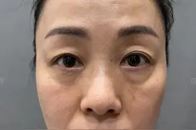 50岁女士，做不开刀去眼袋后，瞬间变年轻了，亲自公开手术过程图片