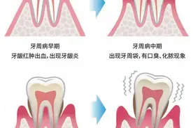 这3种情况的牙龈肿痛不是上火！这样治疗才能有效解决！图片