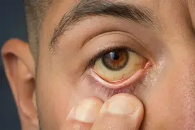 医生提醒：眼睛出现这5种异常，当心是大病前兆！千万别大意了图片