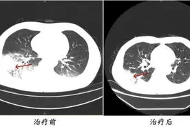 吹了3天空调，男子左肺“白”了一半！专家紧急提醒图片
