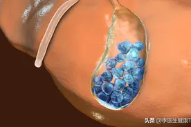 不少B超做出来都显示“胆囊结石”，莫慌，看看医生怎么说！图片
